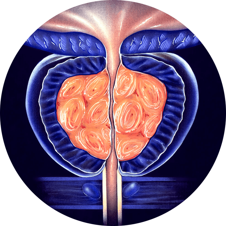 Chronic prostatitis